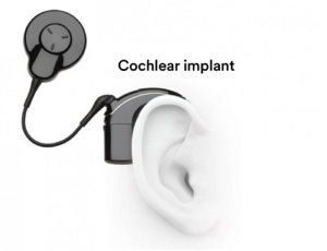 best-cochlear-implant-surat